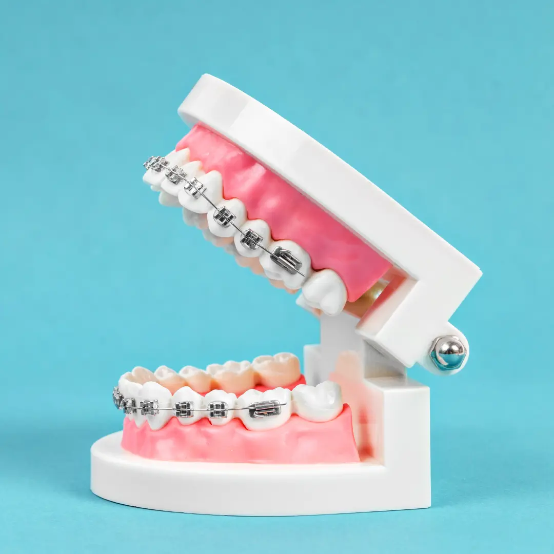 Braces vs lingual braces cost
